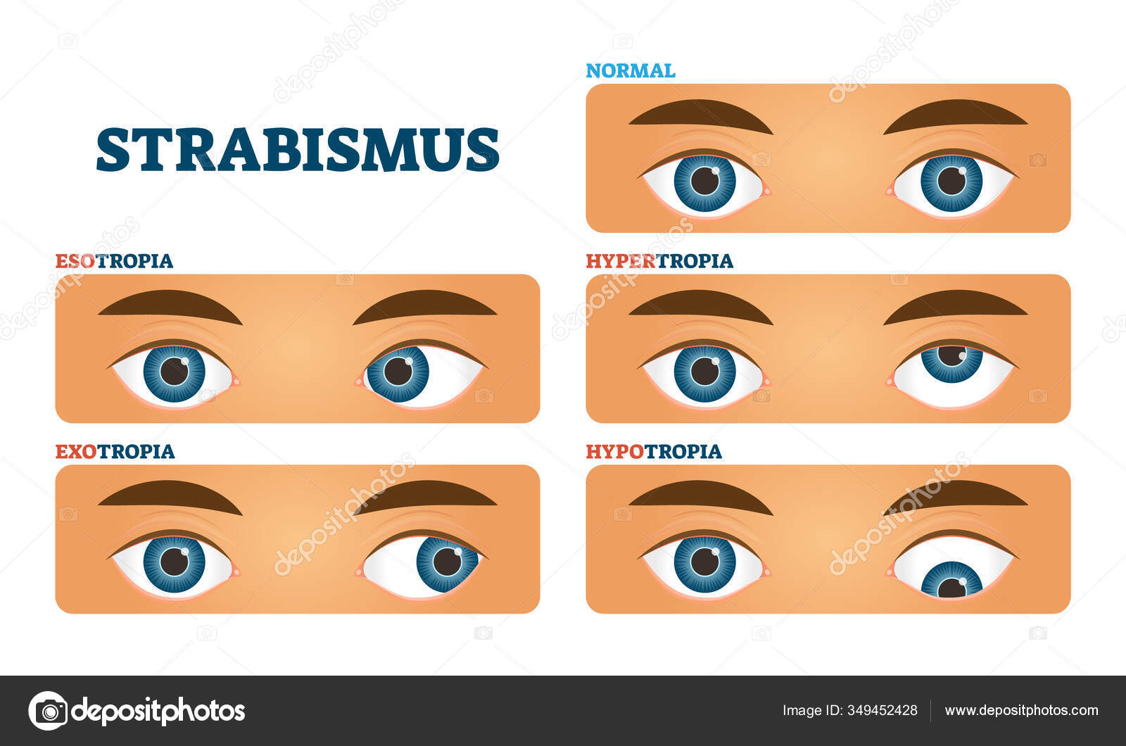 Strabismus or cross eyed vision condition, vector illustrations Stock  Vector Image by ©VectorMine #349452428