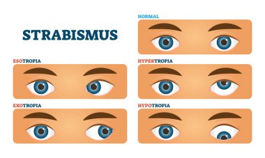 Strabismus veya şaşı görme durumu, vektör çizimleri