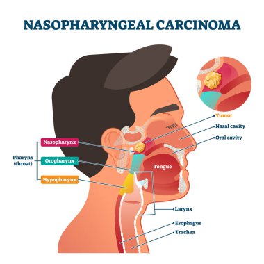 Nasopharyngeal carcinoma tumor, vector illustration clipart