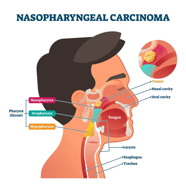 Carcinoma nasofaríngeo tumor, ilustração vetorial — Vetor de Stock