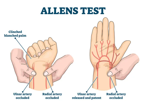 Illustration vectorielle test Allens. Schéma d'examen sanguin artériel physique — Image vectorielle