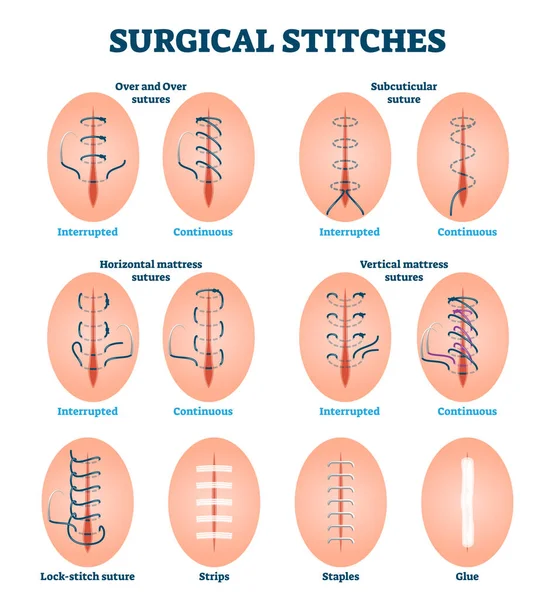 Chirurgische hechtingen vector illustratie. Gelabeld diverse snijwonden behandeling — Stockvector