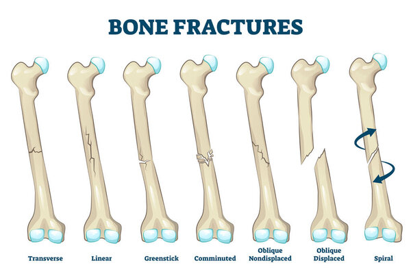 Векторная иллюстрация переломов костей. Разновидность сломанной ноги или руки
