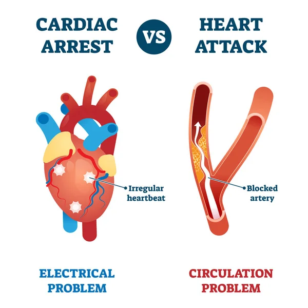 Herzstillstand vs. Herzinfarkt Vektor Illustration. Etikettiertes Gesundheitsproblem. — Stockvektor