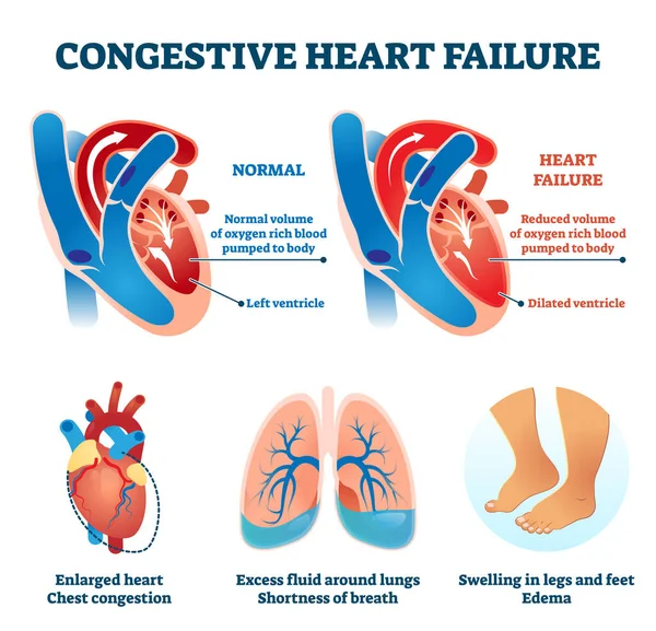 Illustration vectorielle d'insuffisance cardiaque congestive. Schéma de comparaison médicale étiqueté — Image vectorielle