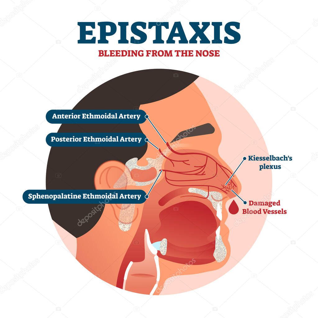 Epistaxis vector illustration. Bleeding from nose explanation health scheme