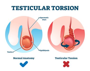 Testicular torsion vector illustration. Labeled spermatic cord twist scheme clipart