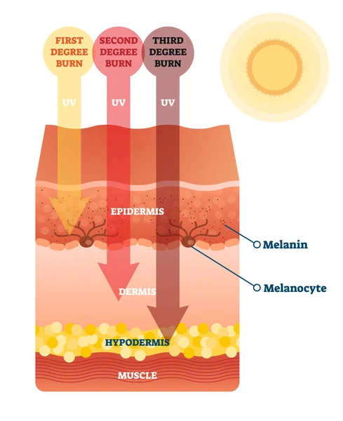 Queimadura solar danos na pele diagrama de seção transversal anatômica —  Vetores de Stock