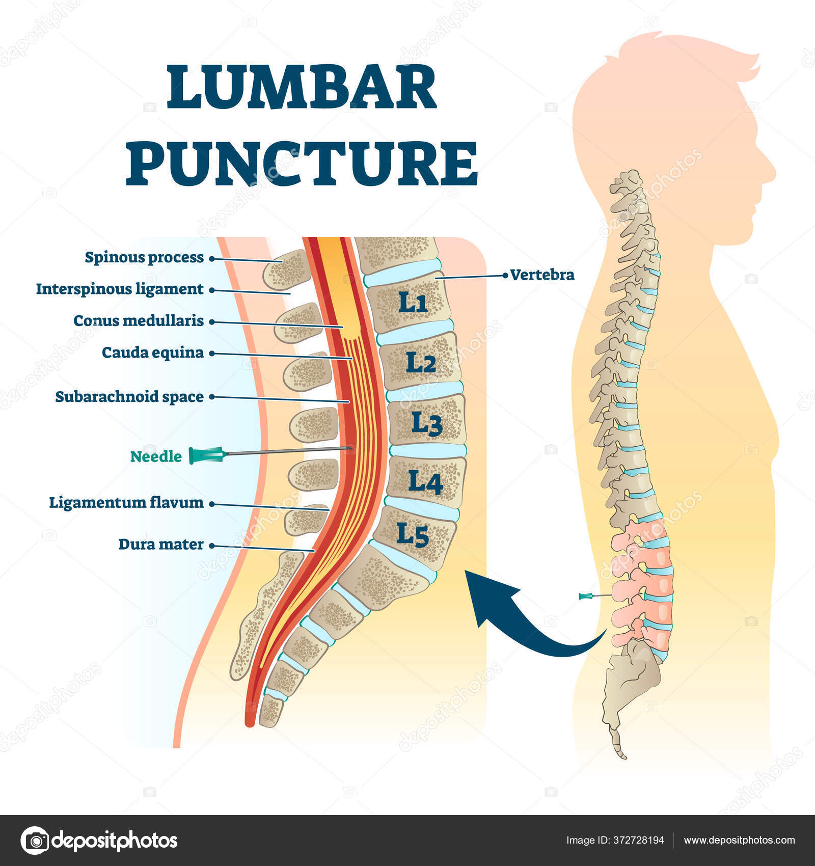 Image vectorielle Illustration vectorielle de ponction lombaire ...