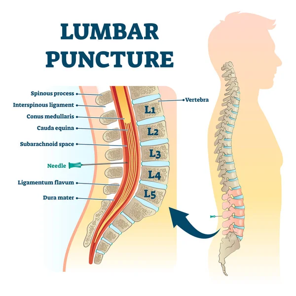 Ilustración del vector de punción lumbar. Esquema de procedimiento de estructura de columna vertebral etiquetado — Vector de stock