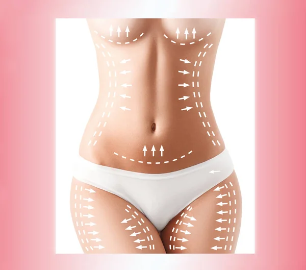 Celluliter avlägsnande planen. Vita tecken på ung kvinna kropp — Stockfoto