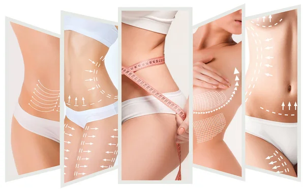 Il piano di rimozione della cellulite. Marcature bianche sul corpo della giovane donna — Foto Stock