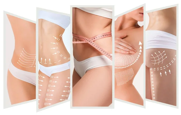 The cellulite removal plan. White markings on young woman body — Stock Photo, Image