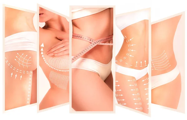 The cellulite removal plan. White markings on young woman body — Stock Photo, Image