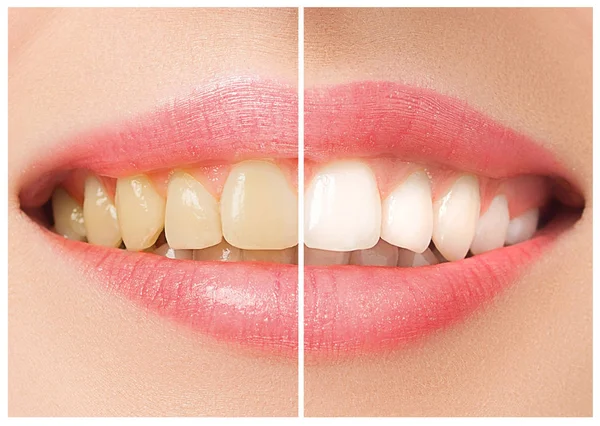 Os dentes femininos antes e depois do clareamento . — Fotografia de Stock