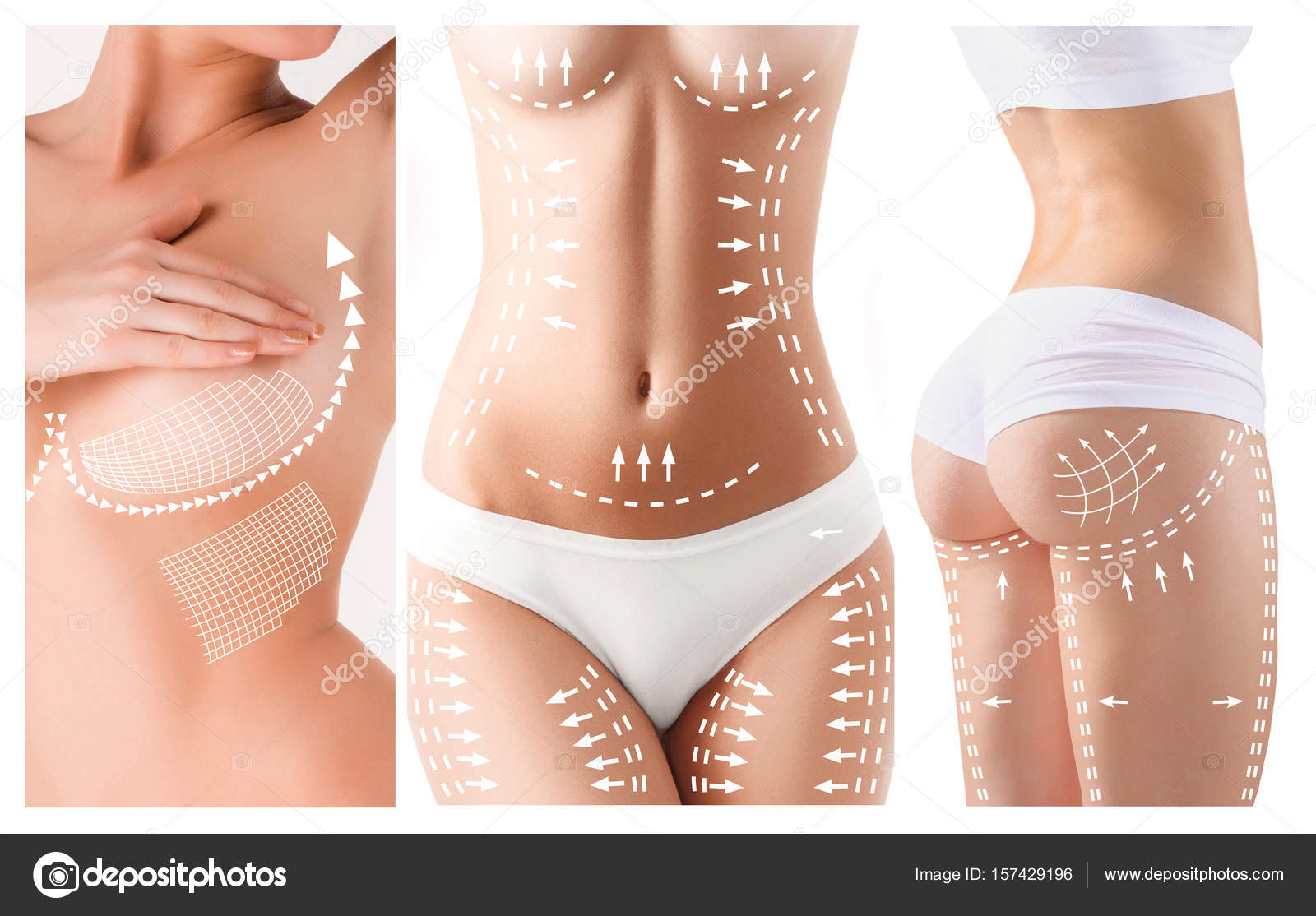 Woman grabbing skin on her flanks with black color crosses marking, Lose  weight and liposuction cellulite removal concept, Isolated on white  backgroun Stock Photo - Alamy