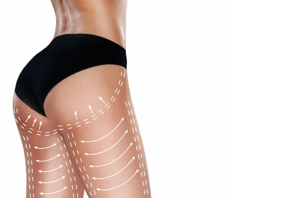 Markierungen am Gesäß, an der Taille und an den Beinen der Frau vor einer Schönheitsoperation. — Stockfoto