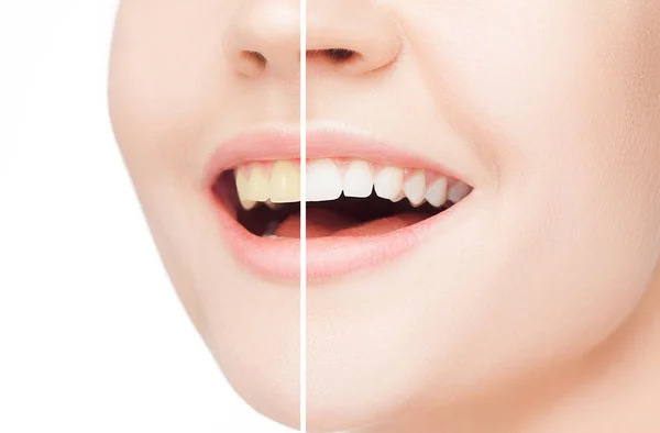 Los dientes femeninos antes y después del blanqueamiento . — Foto de Stock