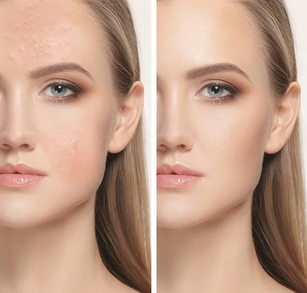 Woman before and after treatment — Stock Photo, Image