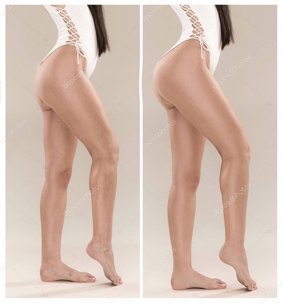 Womans buttocks before and after plastic surgery