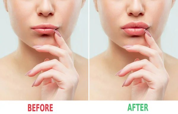 Voor en na de lippen filler injecties. Schoonheid kunststof. Mooie perfect lippen met natuurlijke make-up. — Stockfoto