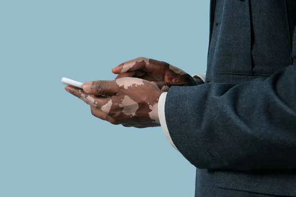 Κοντινό πλάνο των αρσενικών χεριών με χρωστικές λεύκης που απομονώνονται σε μπλε φόντο στούντιο — Φωτογραφία Αρχείου