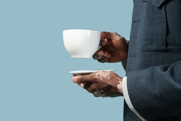 Close up de mãos masculinas com pigmentos vitiligo isolado em fundo estúdio azul — Fotografia de Stock