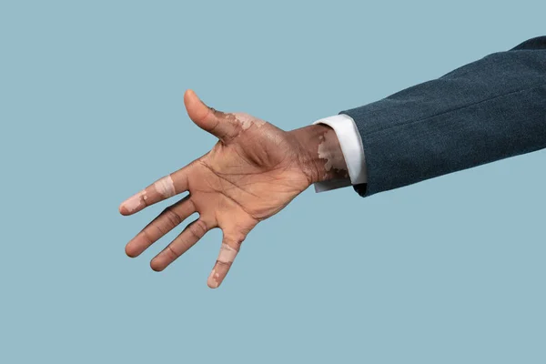 Close up of male hands with vitiligo pigments isolated on blue studio background — Stock Photo, Image