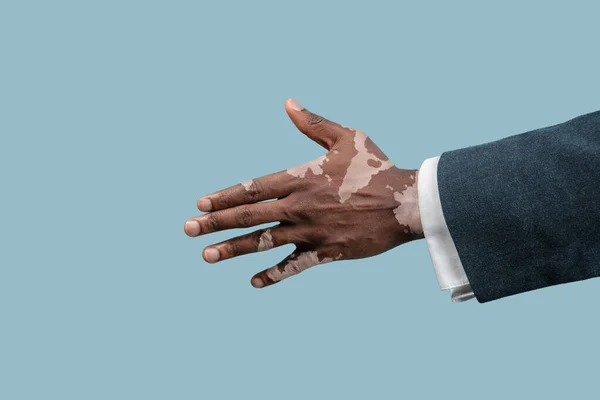 Mavi stüdyo arka planında izole edilmiş vitiligo pigmentleri olan erkeklerin ellerini kapatın. — Stok fotoğraf