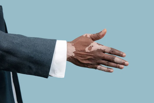 Detailní záběr mužských rukou s vitiligo pigmenty izolované na modrém pozadí studia — Stock fotografie