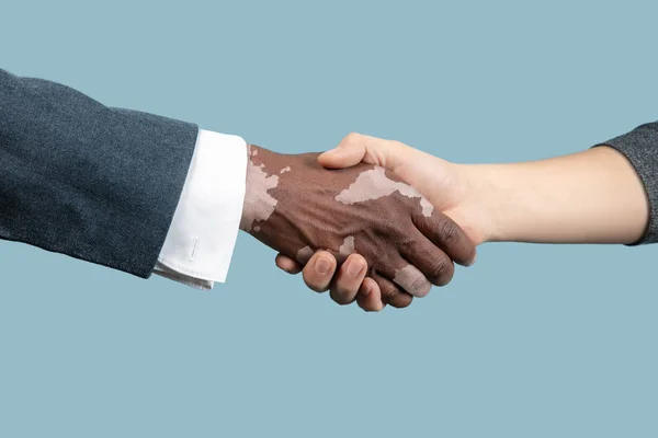 Close up of male hands with vitiligo pigments isolated on blue studio background — Stock Photo, Image