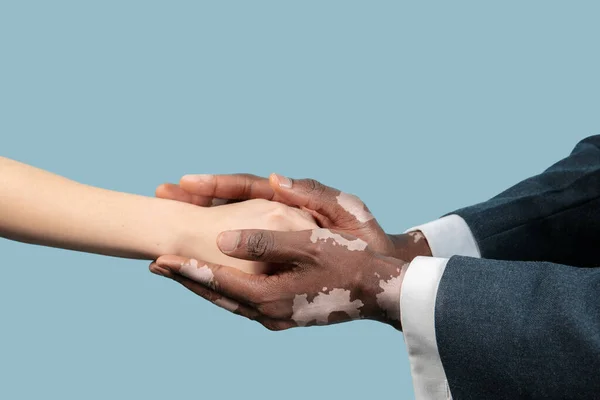 Close up de mãos masculinas com pigmentos vitiligo isolado em fundo estúdio azul — Fotografia de Stock