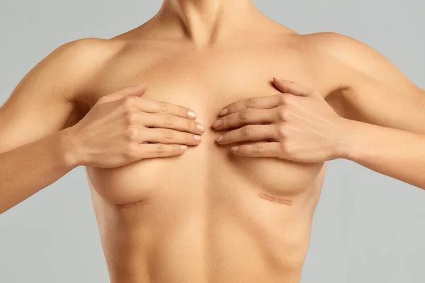 Cirugía plástica de la mama femenina — Foto de Stock