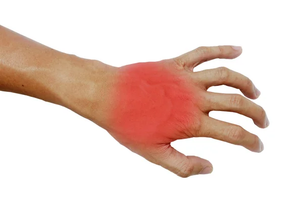 Inflamação muscular na mão, Inflamação muscular na mão de trás Fotos De Bancos De Imagens