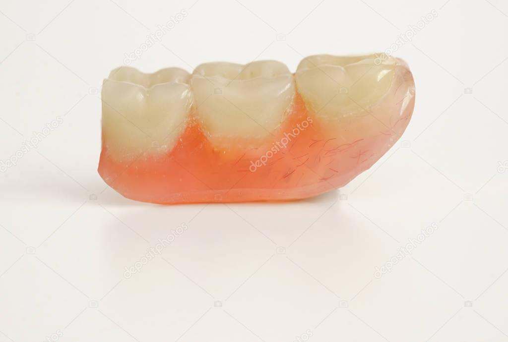 Three prosthetic teeth 