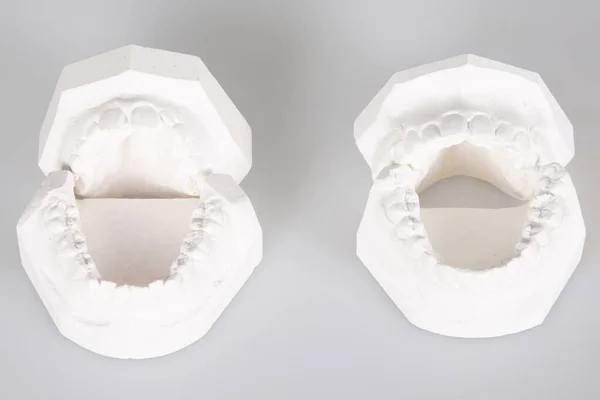 Gipsform Modell Tänder Gjutning Före Efter Behandling Mänsklig Käke — Stockfoto