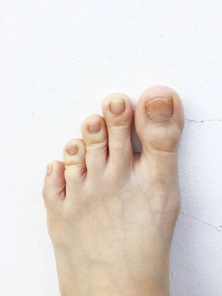 Foot Fingernails Isolated White Top View Fungal Infection Nails Feet — Stock Photo, Image