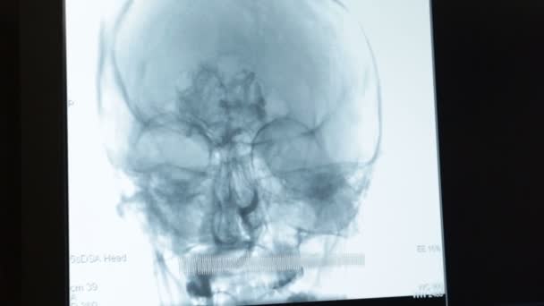 Lidská hlava rentgenový obraz — Stock video