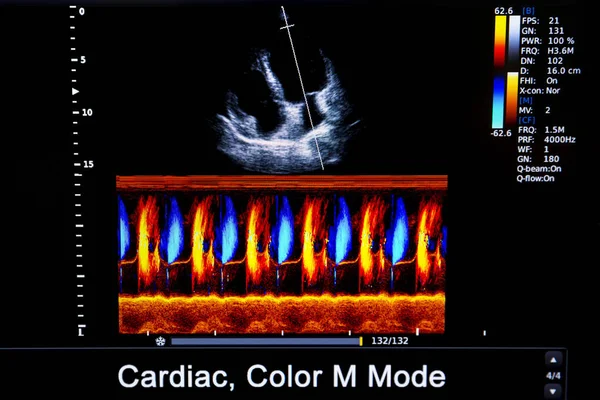 Imagem colorida do monitor de ultrassom cardíaco homan — Fotografia de Stock