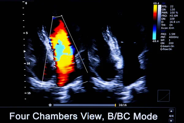 Imagem colorida do monitor de ultrassom cardíaco homan — Fotografia de Stock