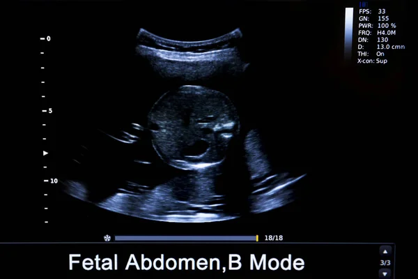 Imagen colorida del monitor de ultrasonido del embarazo — Foto de Stock