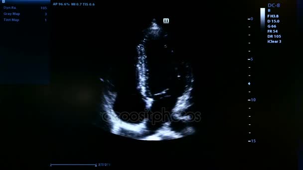 Imagens coloridas do monitor de ultrassom cardíaco homan — Vídeo de Stock