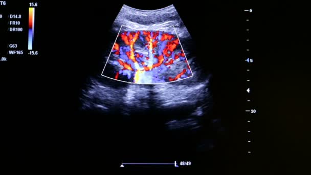 Imágenes coloridas del monitor de ultrasonido del corazón homan — Vídeos de Stock