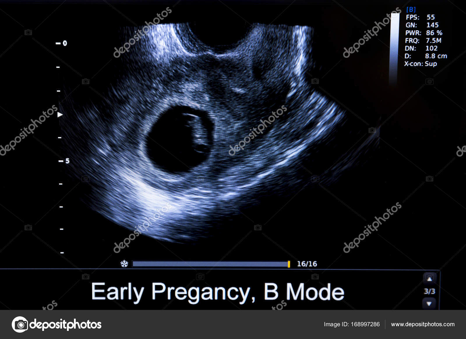 imagenes de ultrasonidos de 3 meses