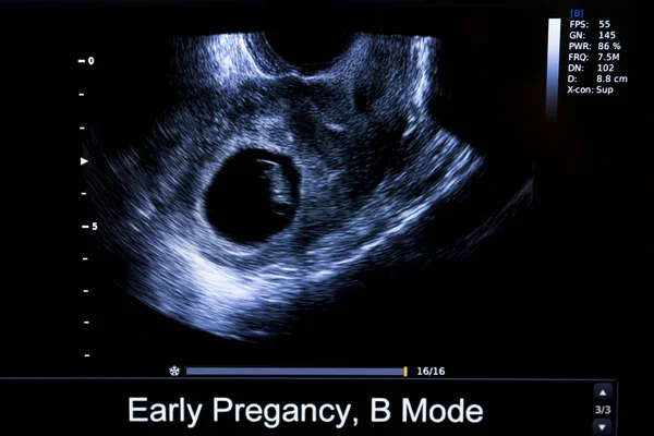 Imagen colorida del monitor de ultrasonido del embarazo — Foto de Stock