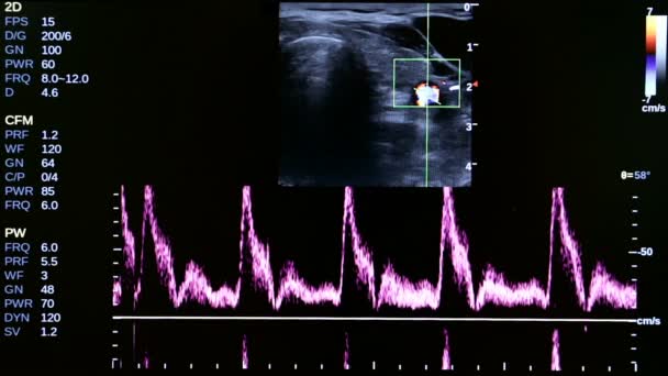 Kleurrijke beelden van moderne echografie monitor — Stockvideo