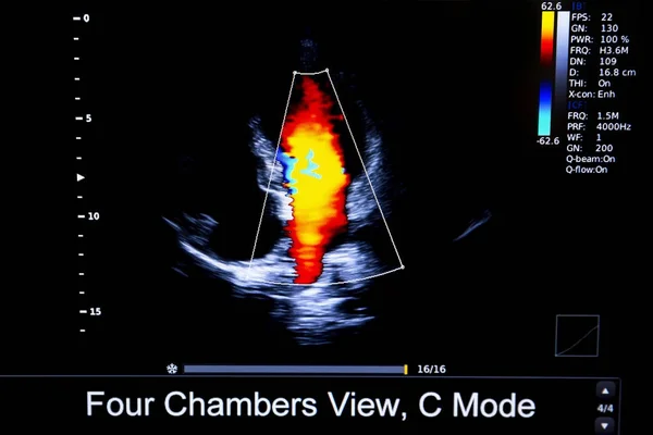 Imagem colorida do monitor de ultrassom cardíaco homan — Fotografia de Stock