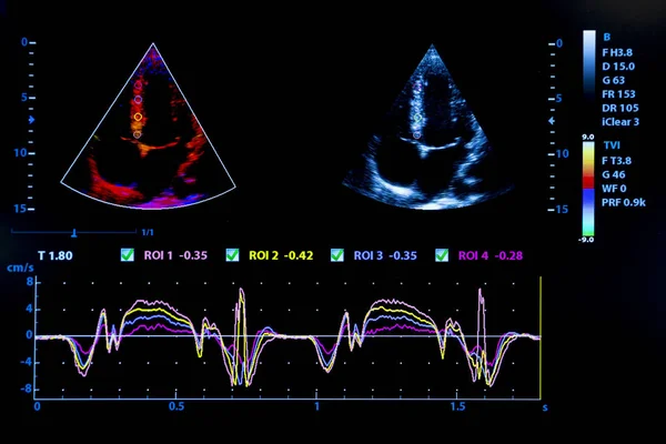 Imagem colorida do monitor de ultrassom cardíaco homan — Fotografia de Stock