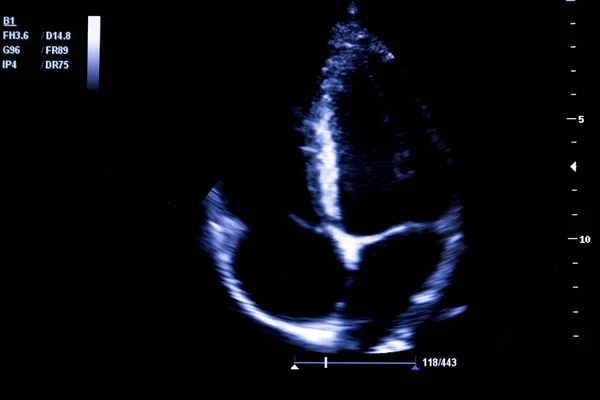 Imagen colorida del monitor de ultrasonido del corazón homan — Foto de Stock