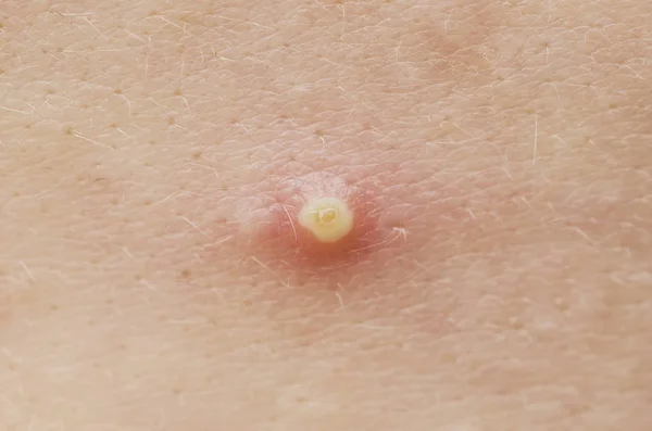 Akne, sivilce closeup makro